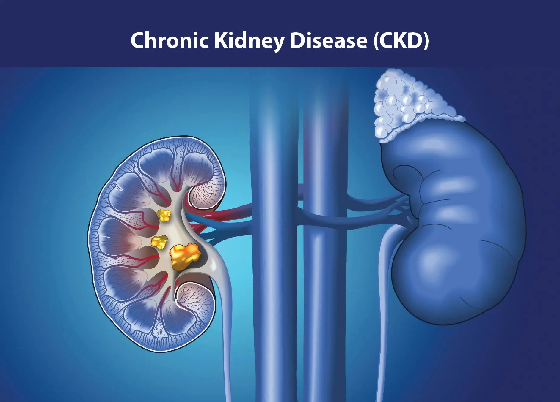 Chronic Kidney Disease (CKD): Awareness, Prevention, and Early Detection